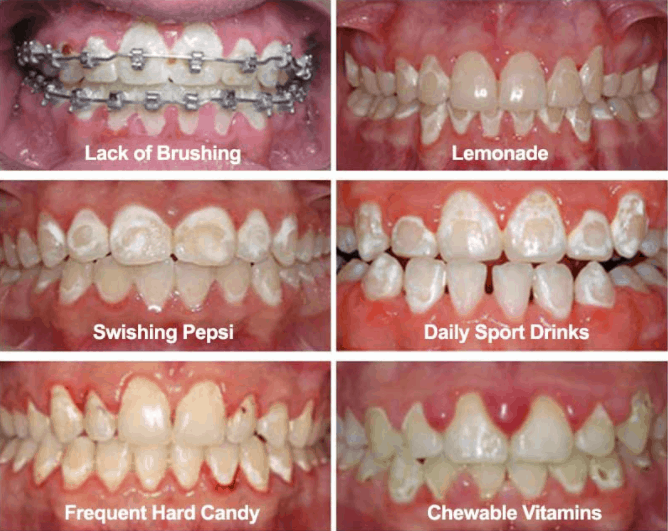 impact of sugary drinks on your teeth