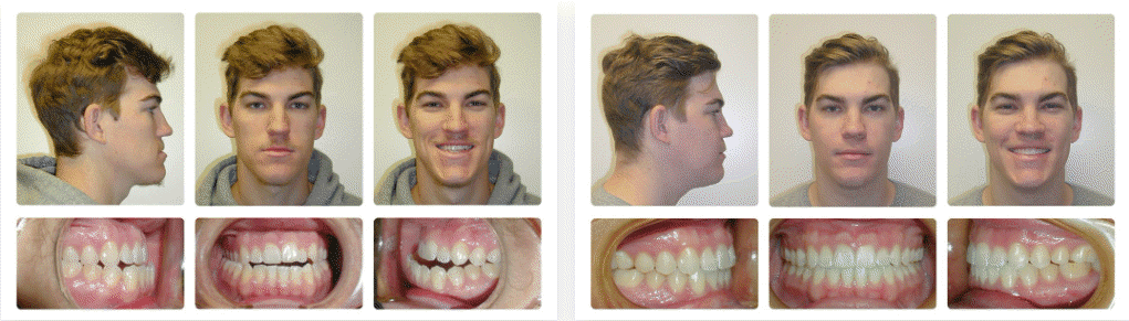 Underbite before and after braces