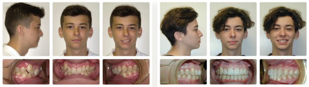 Overbite before and after braces