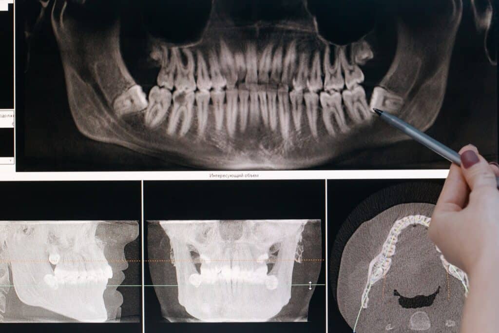 impacted wisdom tooth x-ray